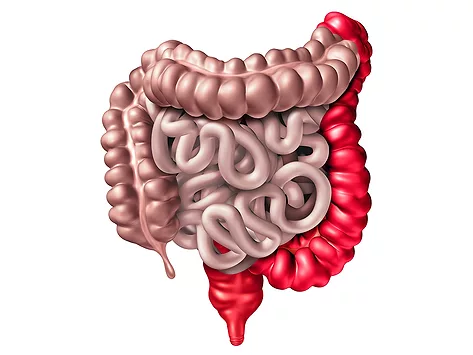 Ulcerative colitis illustration