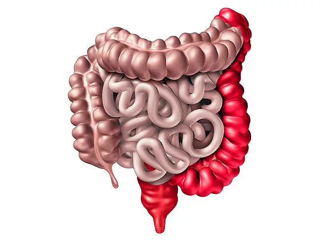 Ulcerative colitis