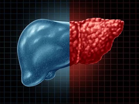 Fatty liver disease