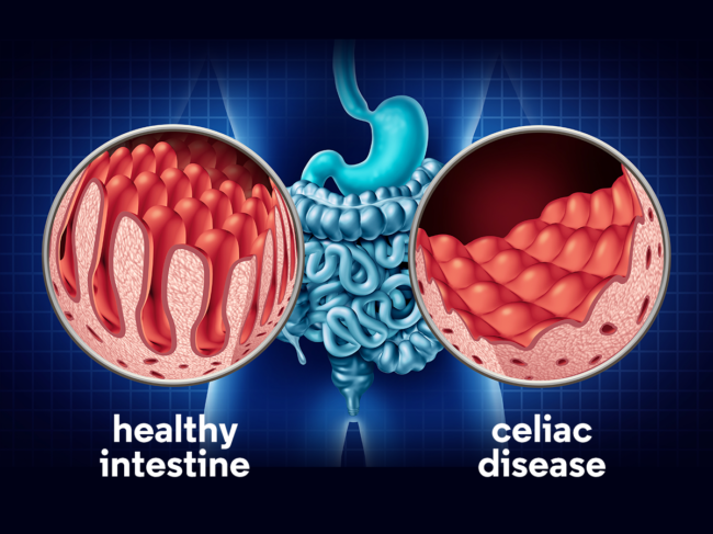 Illustration of gastrointestinal tract comparing normal villi to celiac disease.