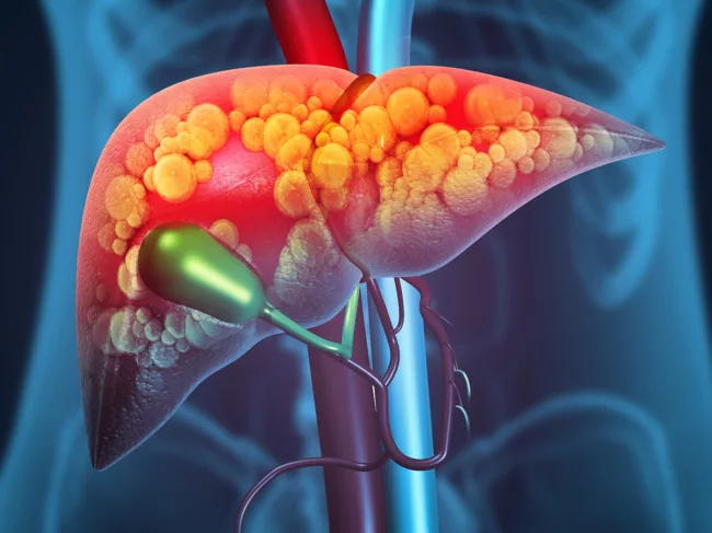 Art concept for liver damage, such as fatty liver, fibrosis or cirrhosis