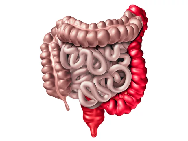Ulcerative colitis