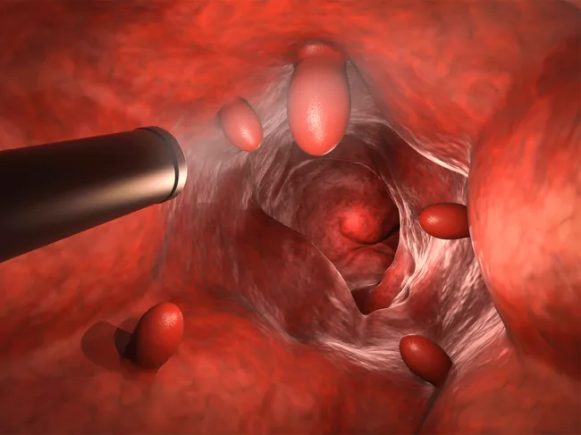 Colonoscopy illustration showing endoscope, polyps in colon