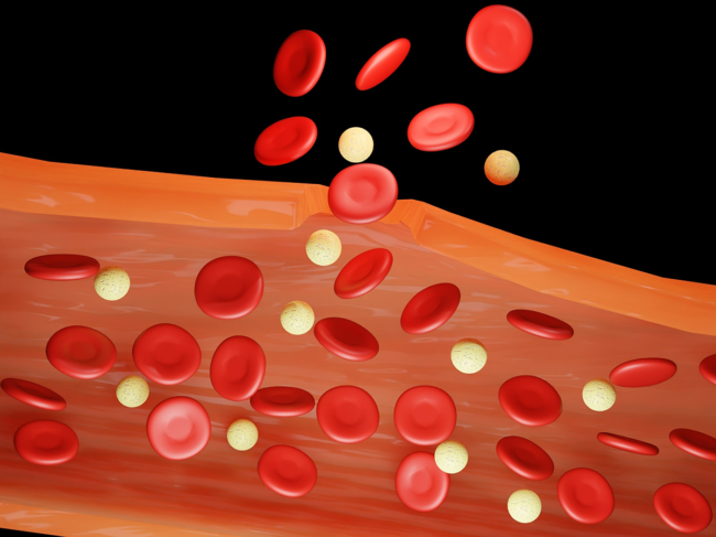Illustration of blood vessel that isn't clotting due to hemophilia
