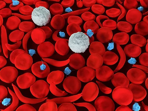 Sickle cell pic