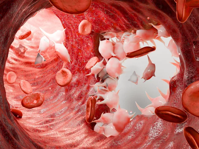 Illustration of hole in vessel wall with repair process in progress