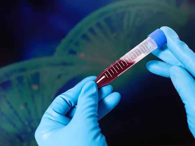 Hemophilia-test-tube-dna