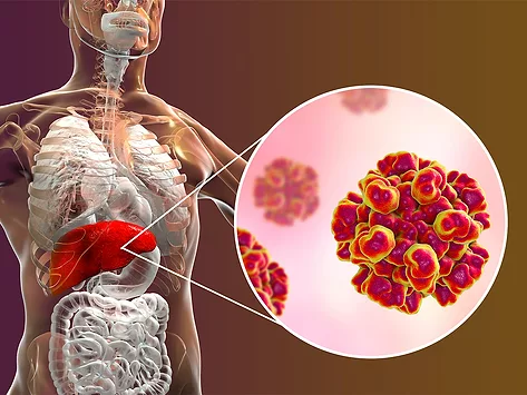 Liver infection hepatitis e virus