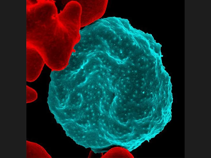 Red blood cell infected with malaria parasites Red blood cell infected with malaria parasites