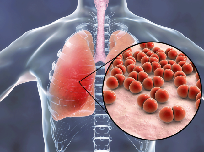 Streptococcus pneumoniae in lungs