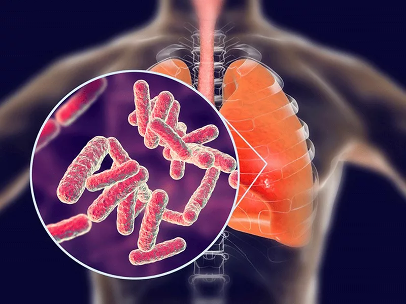 Tuberculosis Tuberculosis