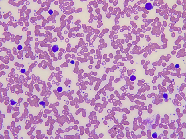 Blood smear of a patient with mononucleosis