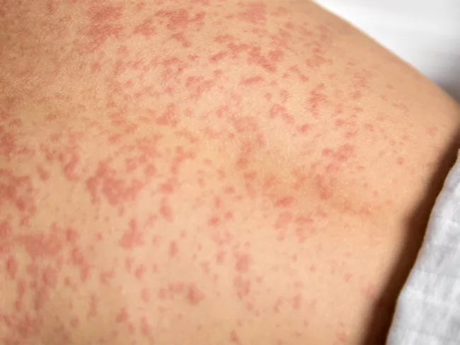 Photo of measles rash on skin