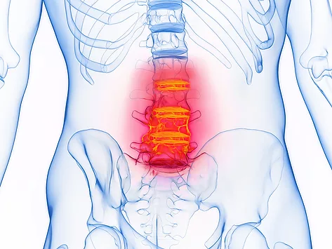 Inflamed lumbar spine disc