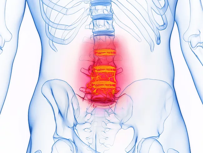 Illustration of inflamed spine