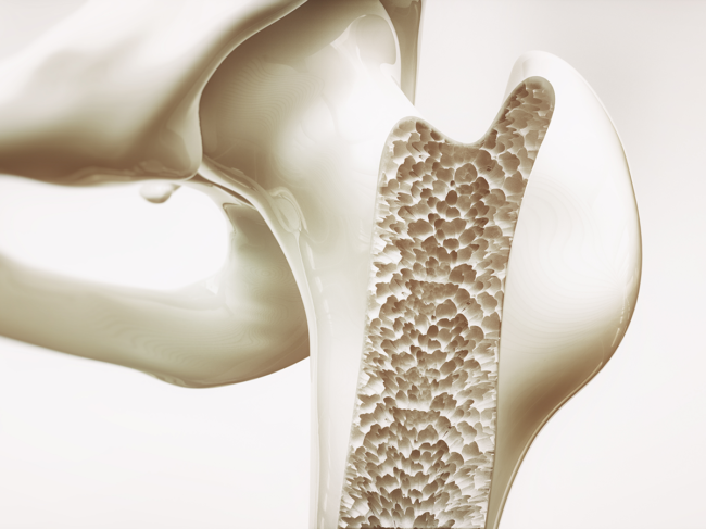 3D rendering showing osteoporosis in the femur