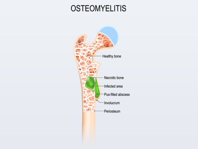 Illustration of osteomyelitis