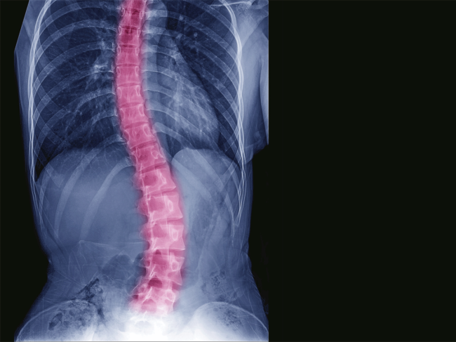 X-Ray showing scoliosis