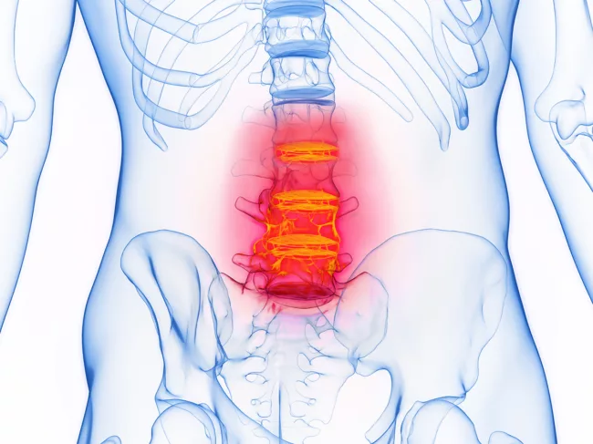 Illustration of inflamed spine
