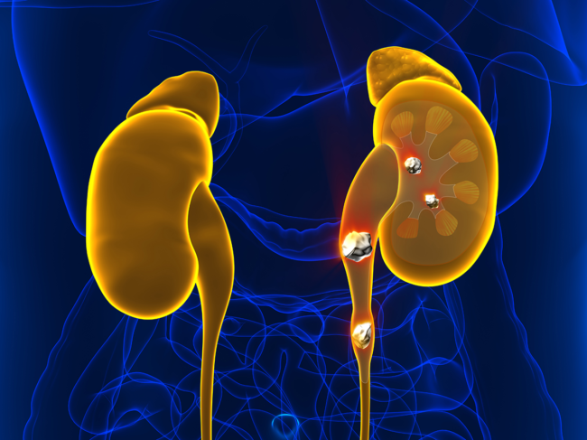 Illustration if kidney organs, kidney stones