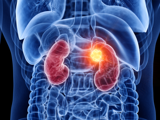 Illustration of tumor on kidney