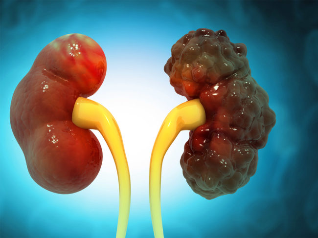Illustration of polycystic kidney