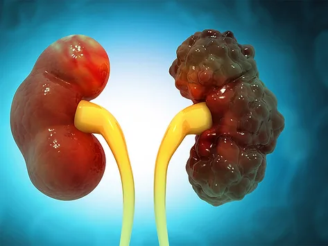 Polycystic kidney disease