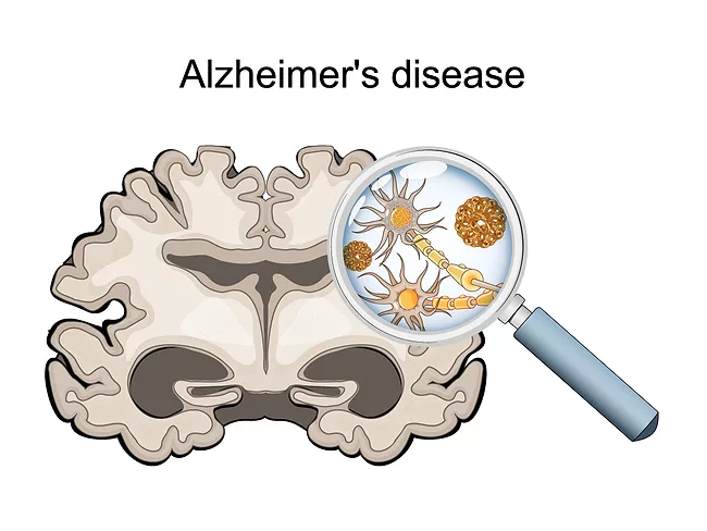 Illustration of Alzheimer's disease in the brain