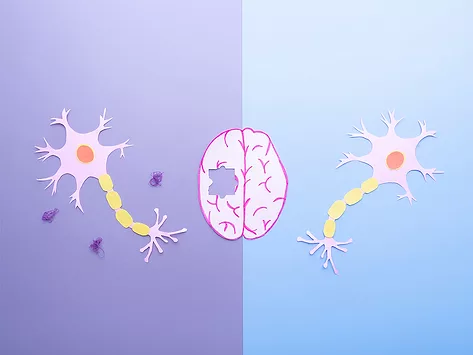Comparison of neurons in a healthy brain and nerve cells in neurodegenerative disease with amyloid plaques