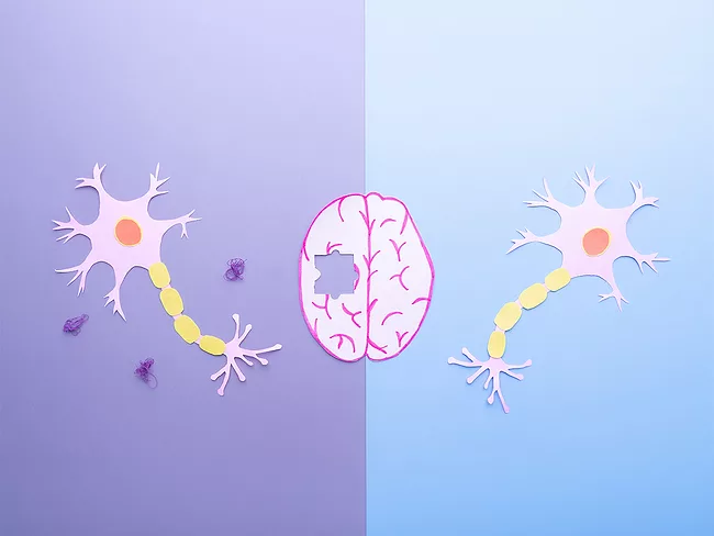 Comparison of neurons in a healthy brain and nerve cells in neurodegenerative disease with amyloid plaques