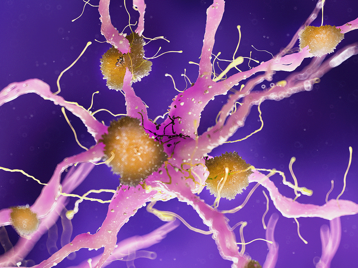 Amyloid plaque on nerve cell
