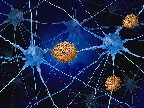 Illustration of amyloid plaques on neurons