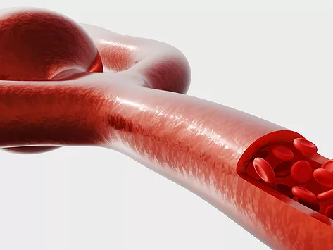 Cerebral aneurysm illustration