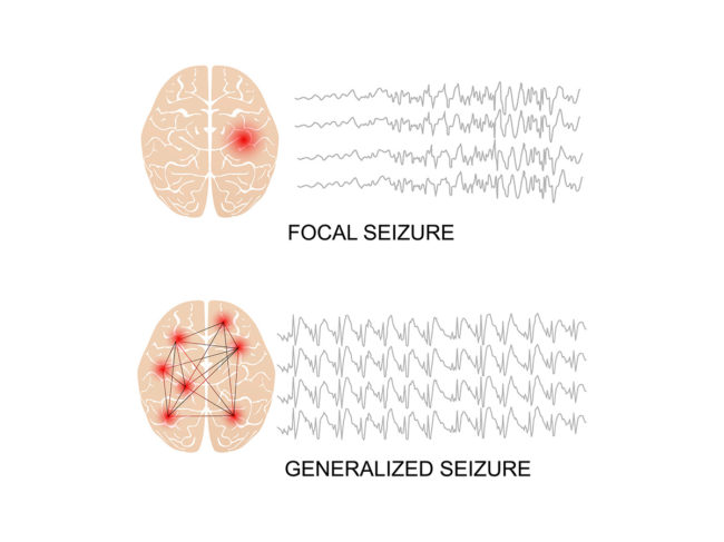Illustration showing the difference between focal and generalized seizures