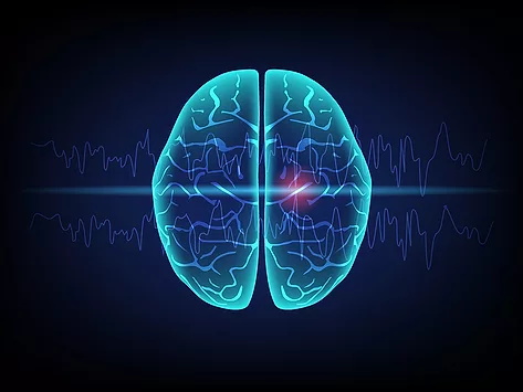 Illustration of brain and brain waves, concept of focal seizure