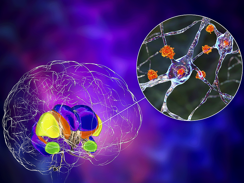 Anle-138b reduces mHTT aggregation, improves pathological phenotypes in Huntington’s models