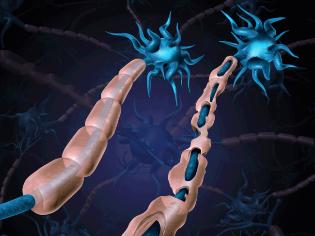 Multiple sclerosis-damaged myelin