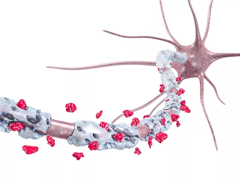 Neuron destruction of myelin