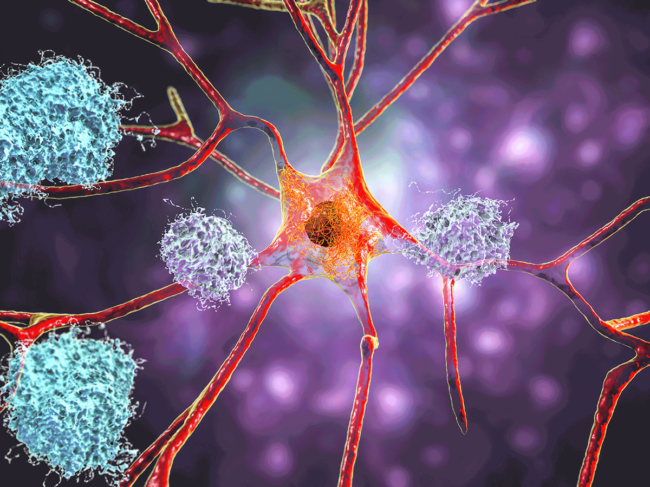 Neurons and amyloid plaques