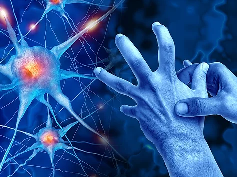 Art concept for Parkinson's disease