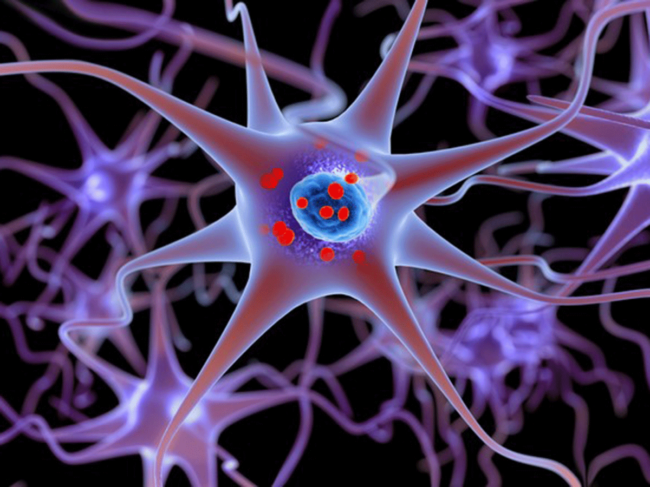 Parkinson's disease illustration showing neurons containing alpha-synuclein