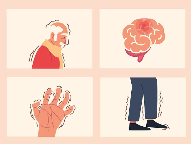 Illustration depicting symptoms of Parkinson’s disease
