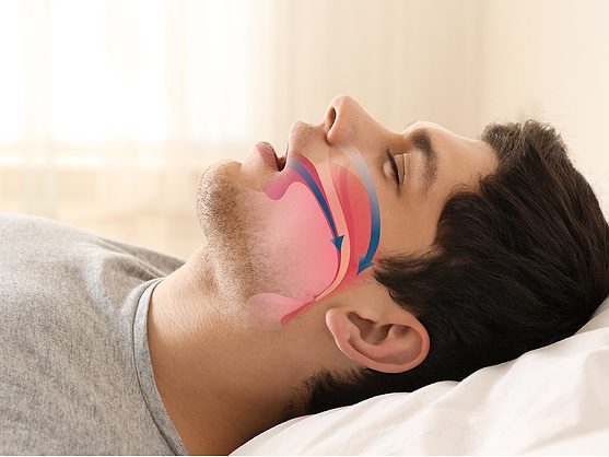 retatrutide sleep apnea Lilly's GLP-1/GIP tirzepatide clears sleep apnea phase III hurdle