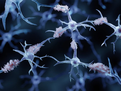 Illustration of amyloid plaques in Alzheimer's disease