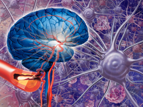 Stroke illustration: brain, artery, neurons