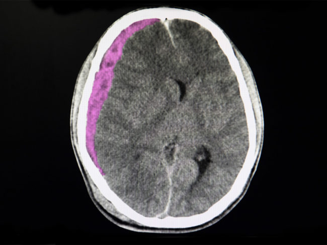 CT scan of brain showing subdural hematoma