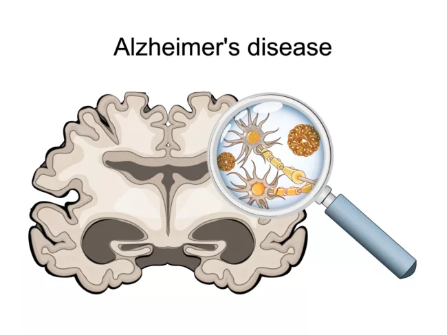 Illustration of Alzheimer's disease in the brain