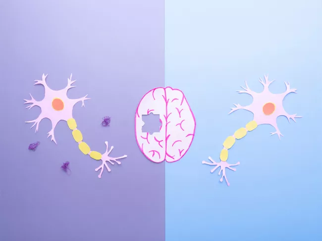 Comparison of neurons in a healthy brain and nerve cells in neurodegenerative disease with amyloid plaques