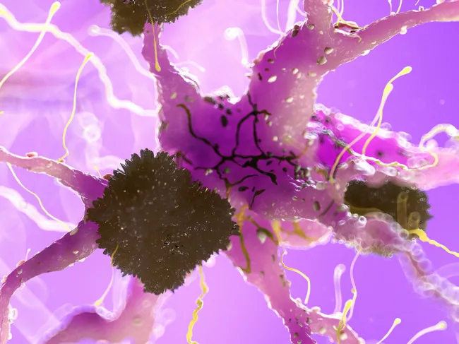 Amyloid plaques on nerve cell