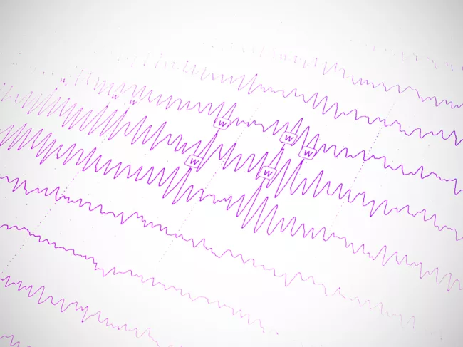 Electroencephalogram 